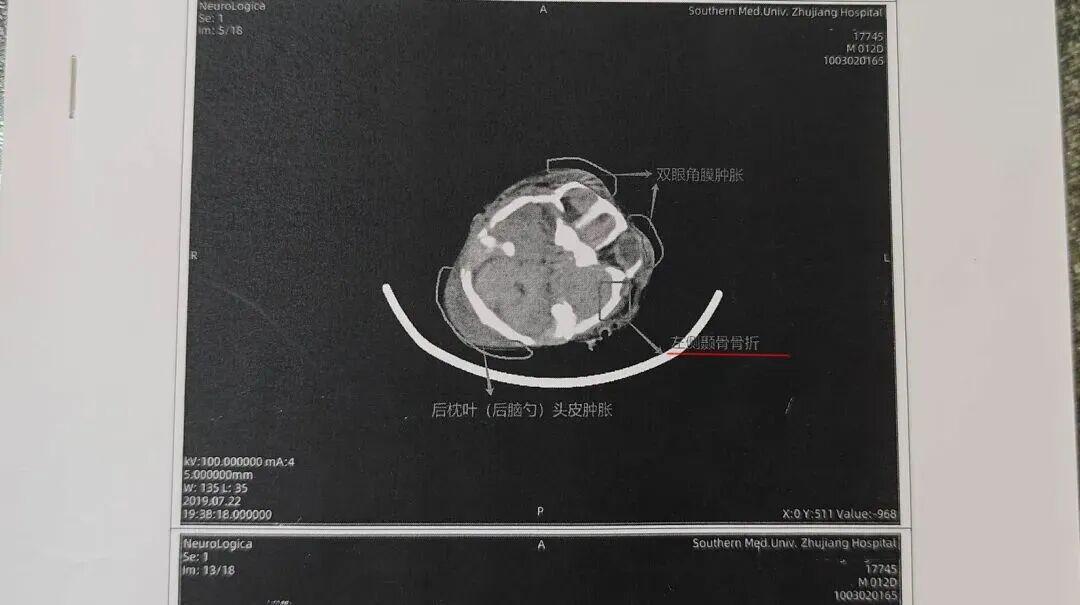 开云体育下载-从“满分新生儿”到7年脑瘫治疗，CT爆真相：孩子出生被摔过头！